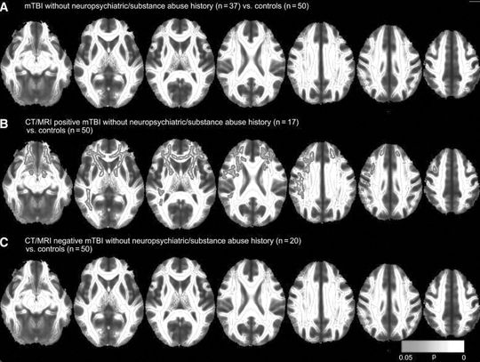 New blood test helps reveal brain injuries